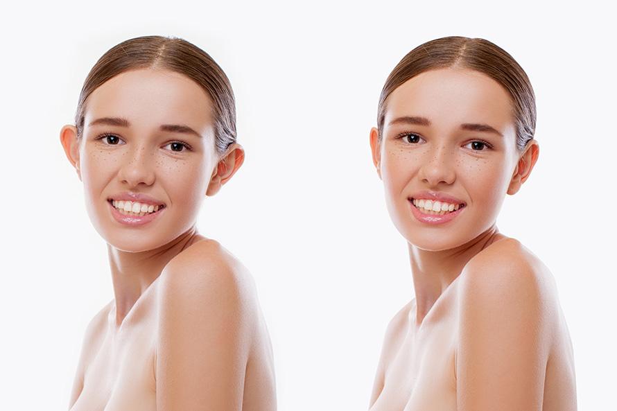 Know About Otoplasty