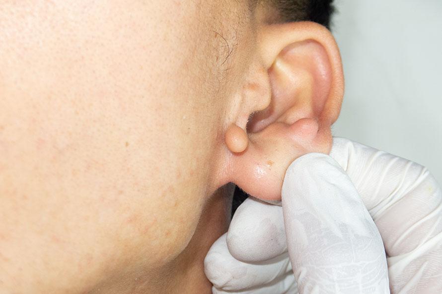 Removing ear skin tags with otoplasty