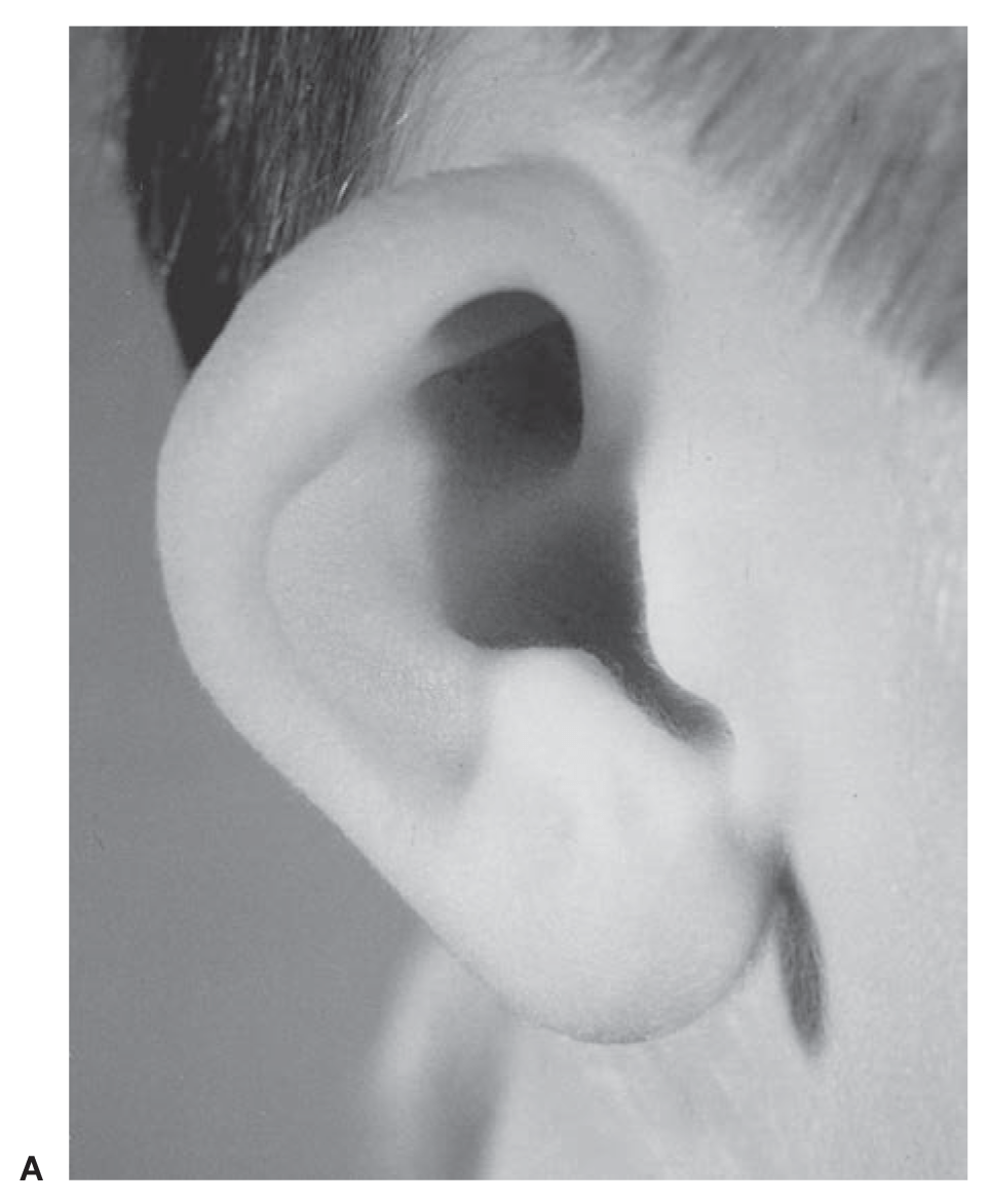 Constricted ear A