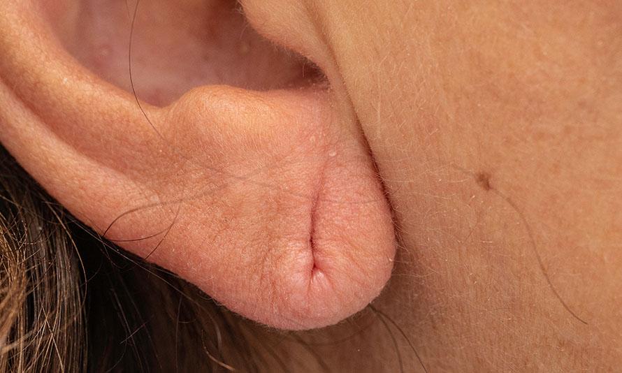 droopy earlobe