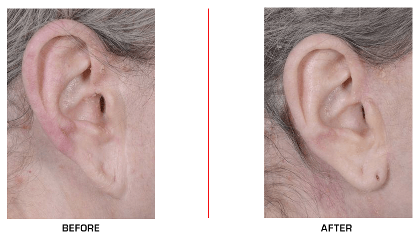 ear distortion