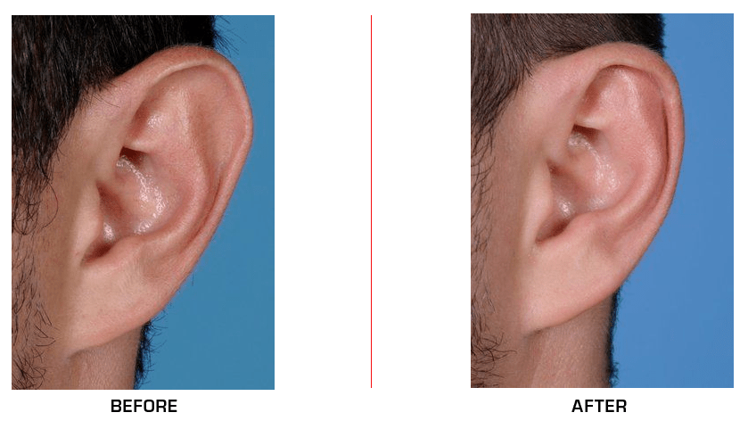 ear reduction case1