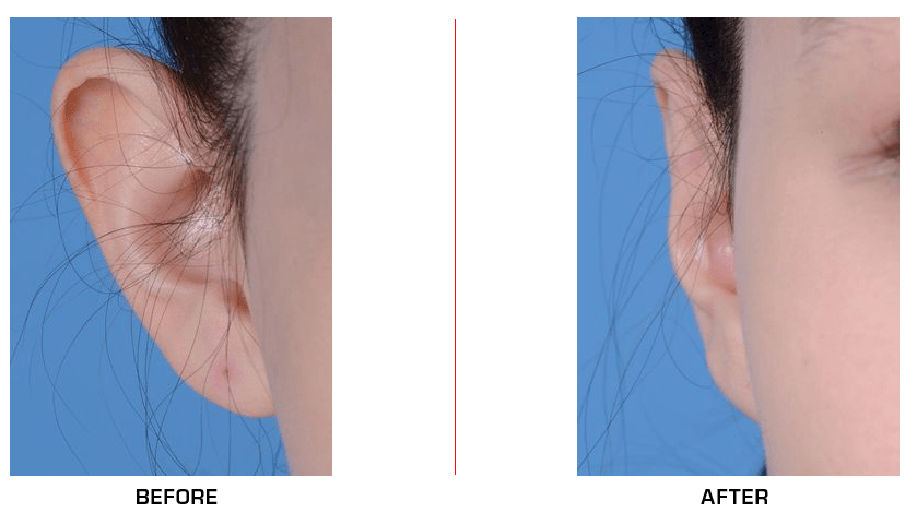 otoplasty before after case1