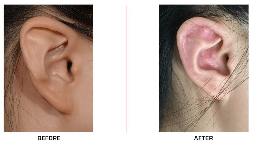 Stahl's Ear before after case